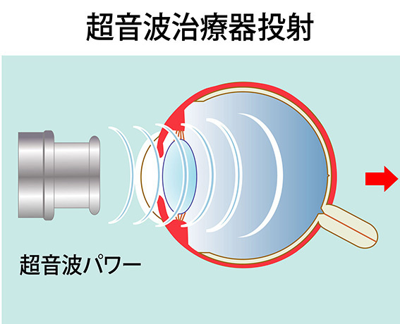 ドクタービジョンの作用は❶毛様体筋のコリをほぐす❷血行をよくする